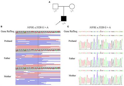 Case Report: Prenatal Whole-Exome Sequencing to Identify a Novel Heterozygous Synonymous Variant in NIPBL in a Fetus With Cornelia de Lange Syndrome